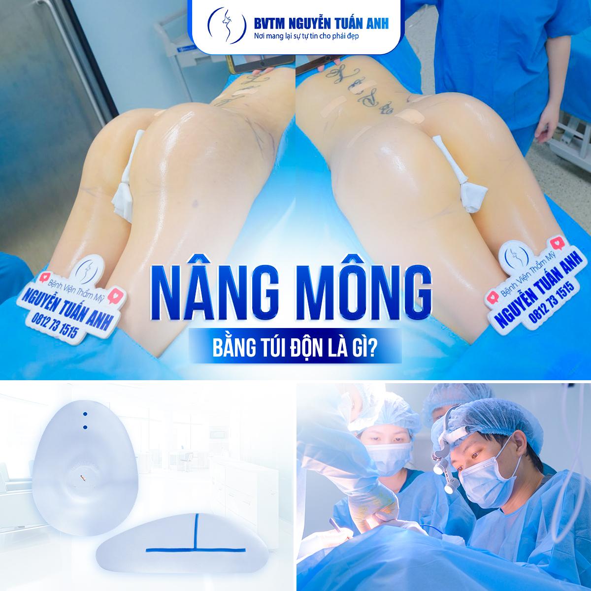 Nâng mông bằng túi độn