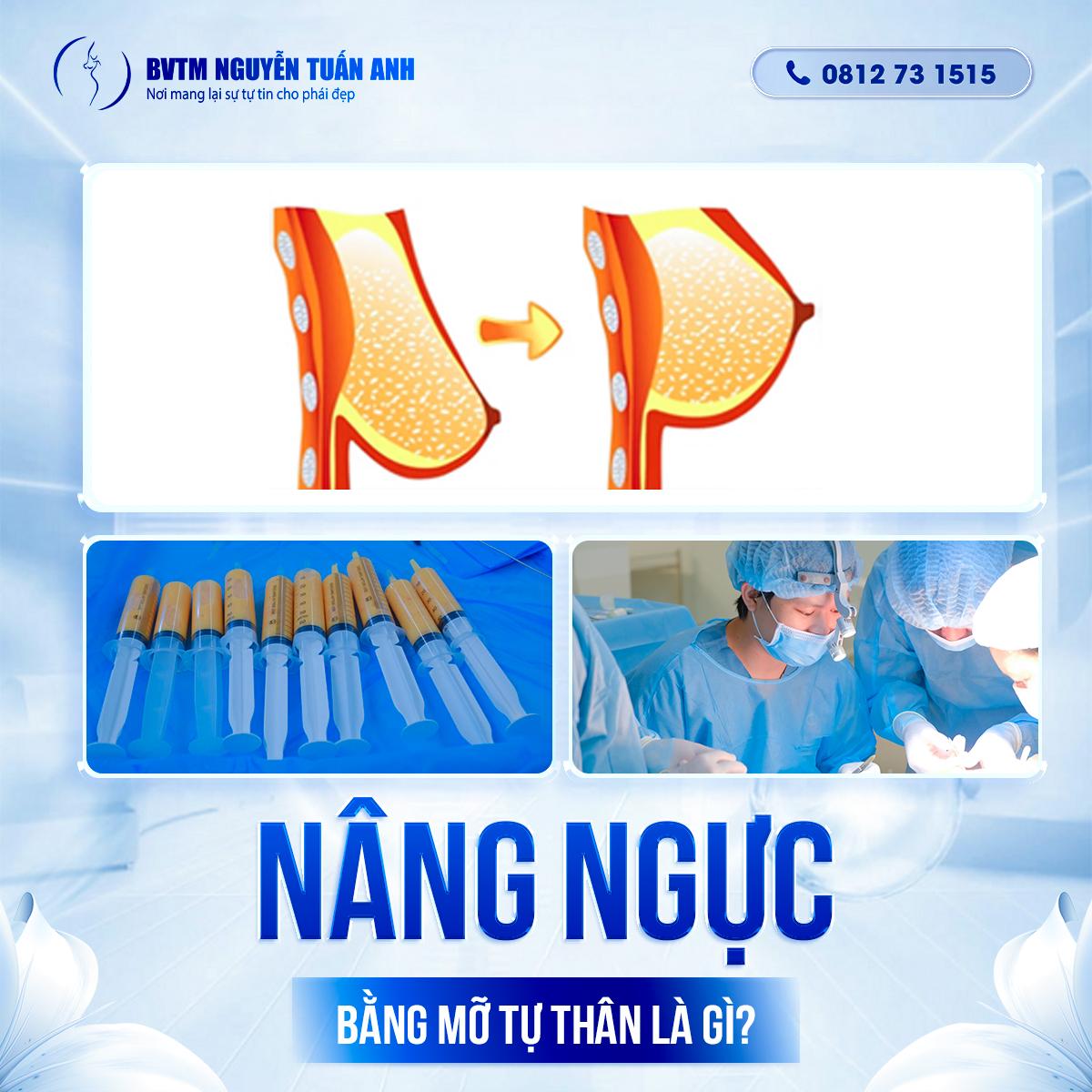 Nâng ngực mỡ tự thân