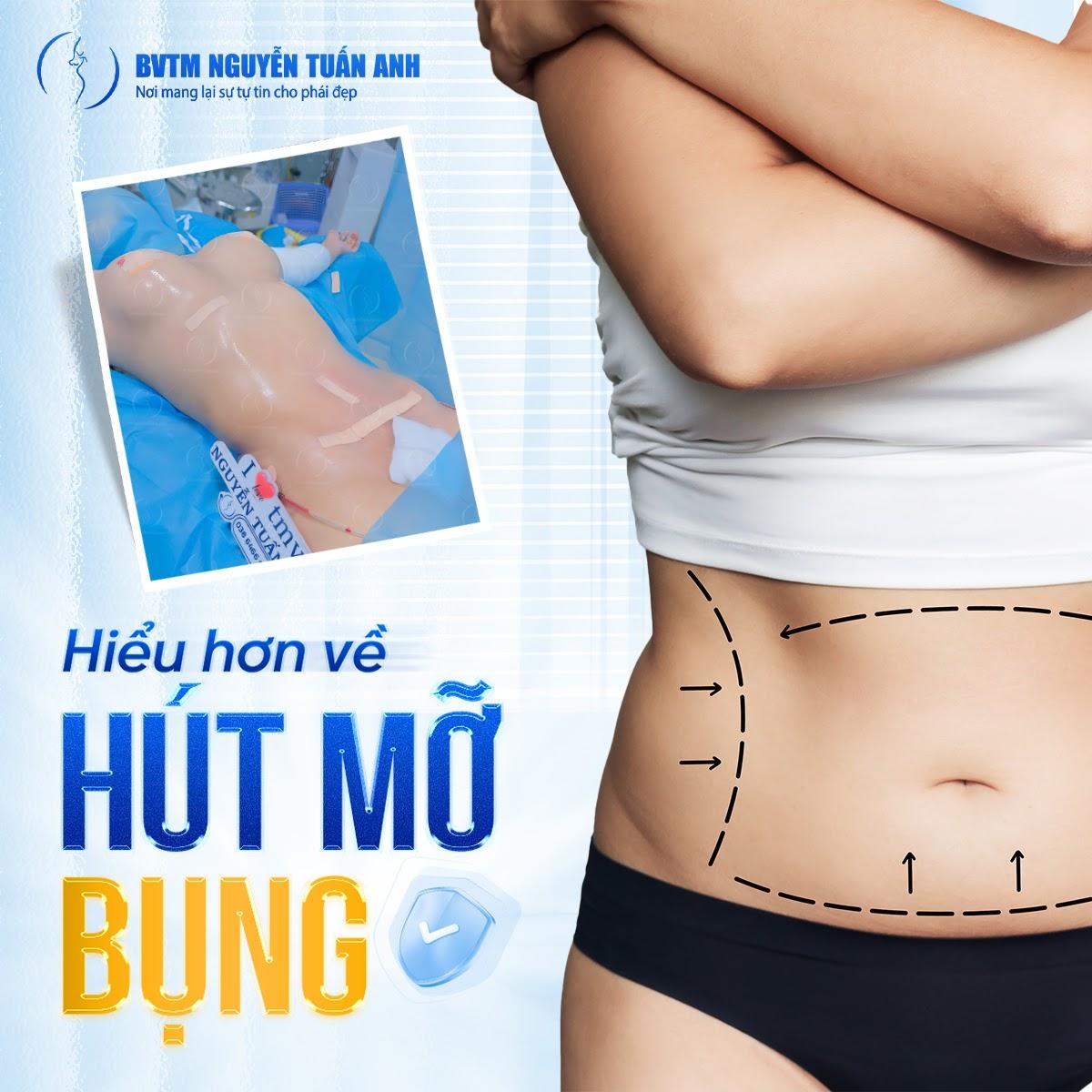 Hút mỡ bụng