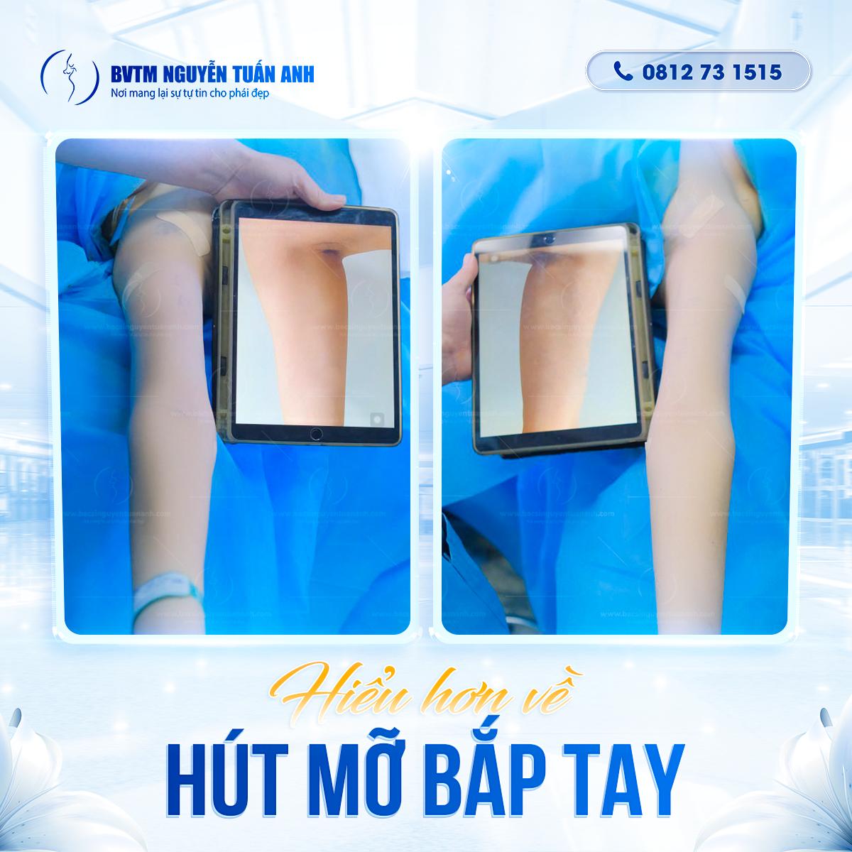 Hút mỡ bắp tay