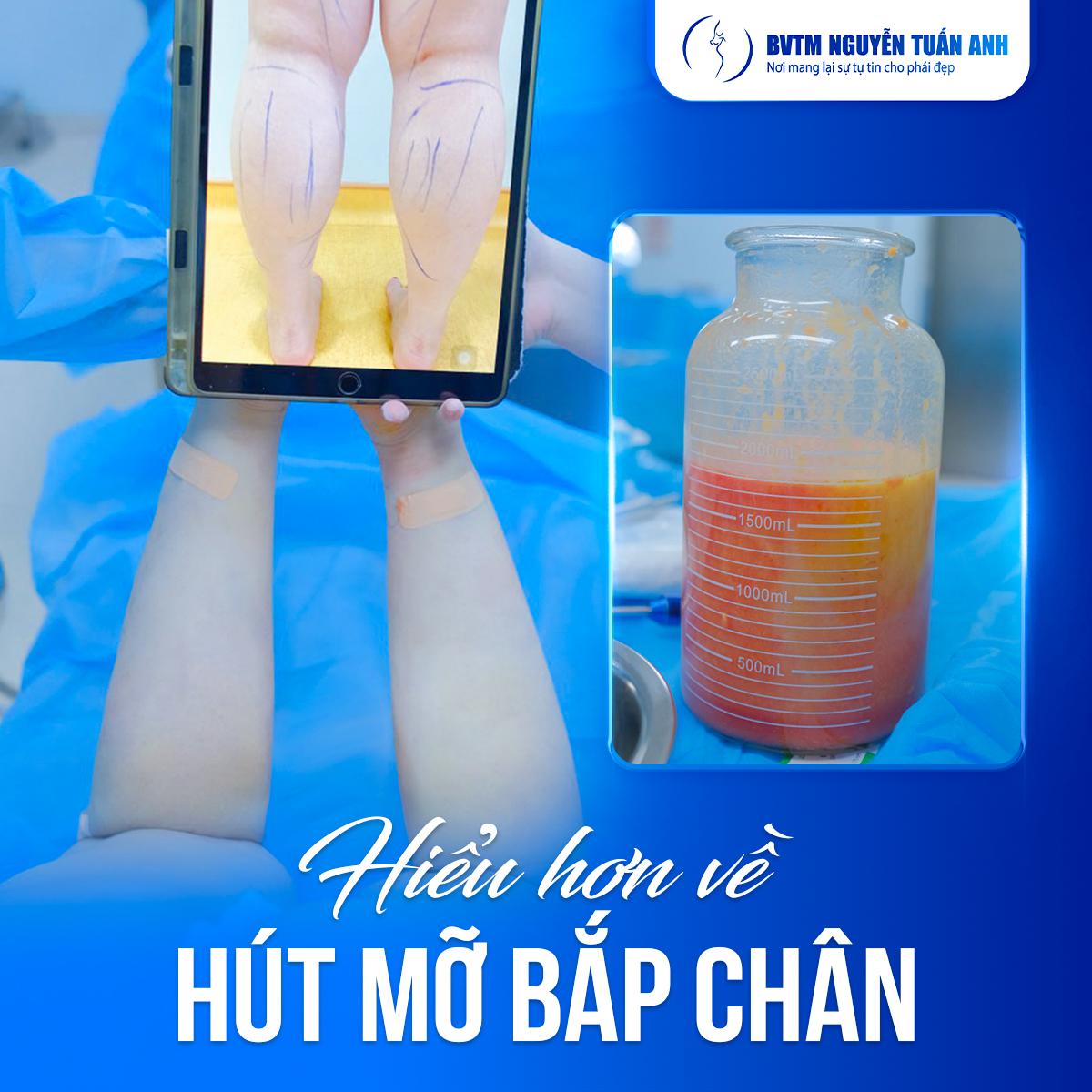 Hút mỡ bắp chân