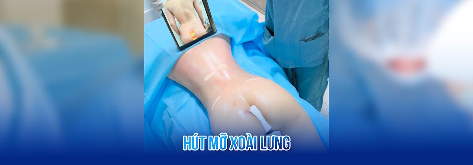 Hút mỡ xoài lưng