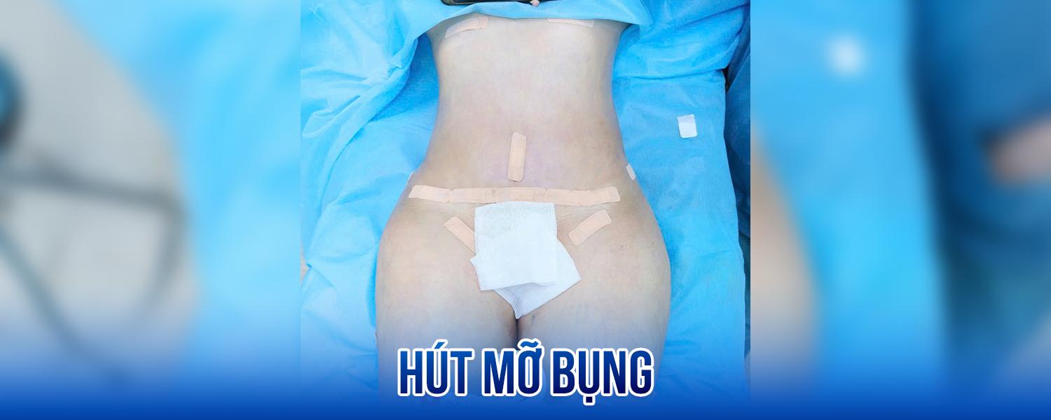 Hút mỡ bụng là gì? 