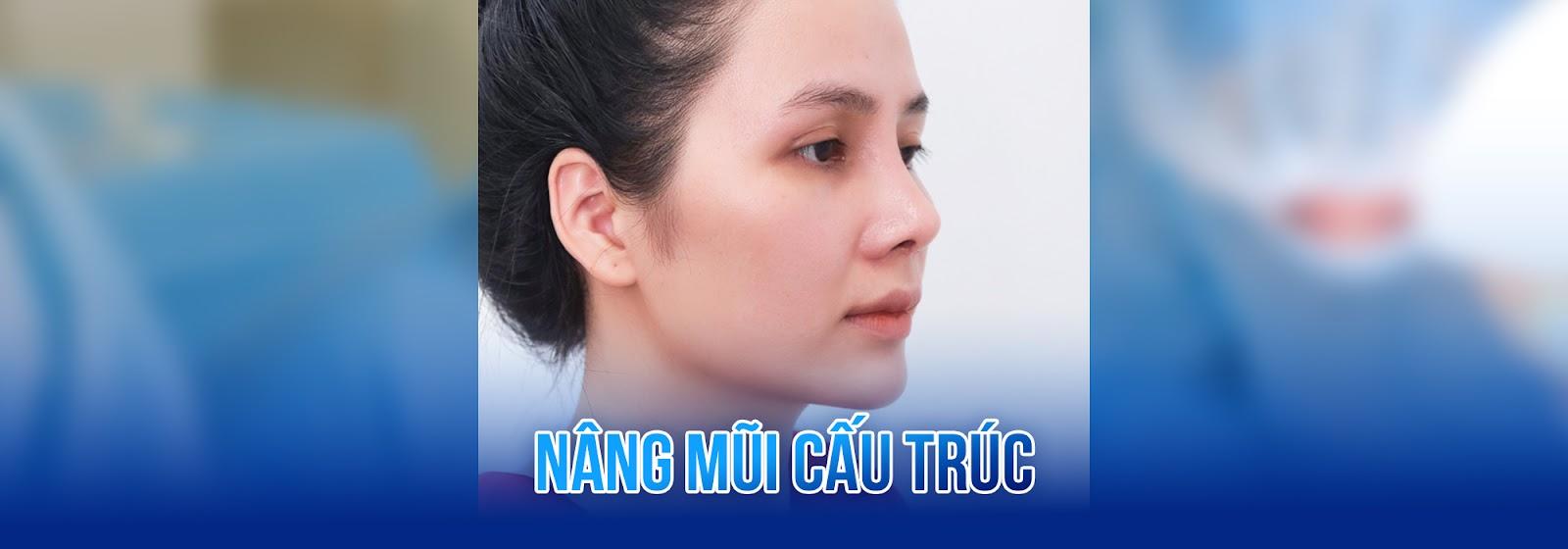 Nâng mũi cấu trúc