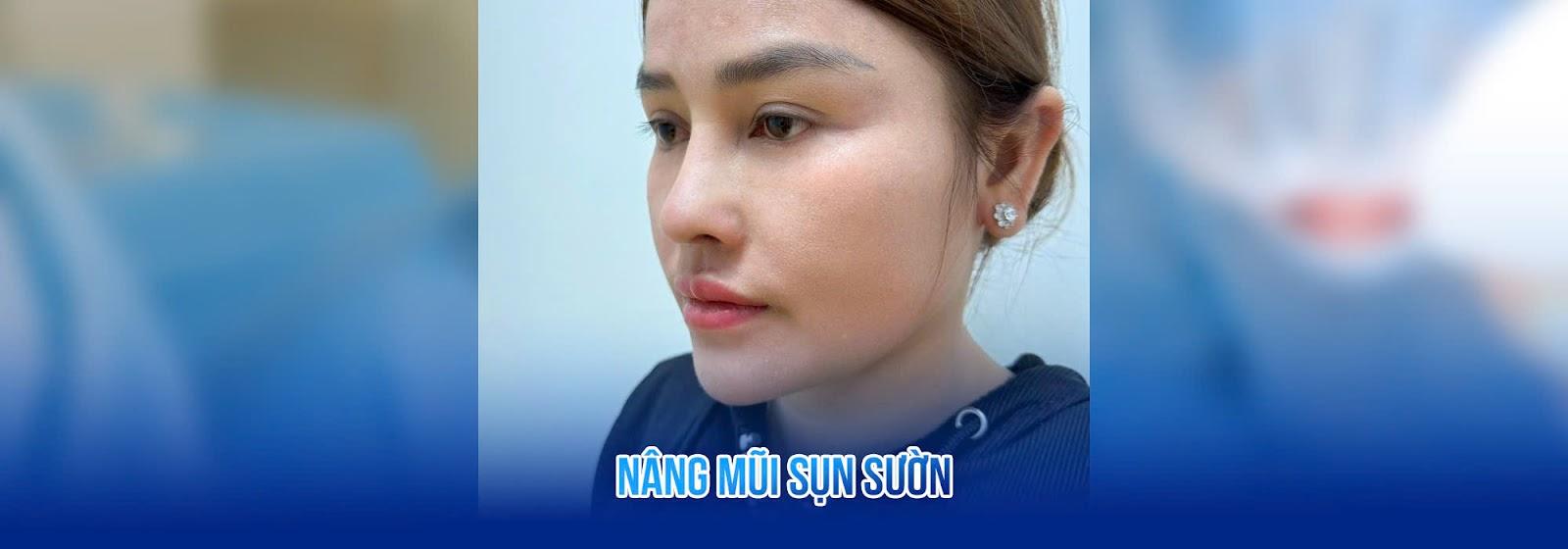 Nâng mũi cấu trúc sụn sườn