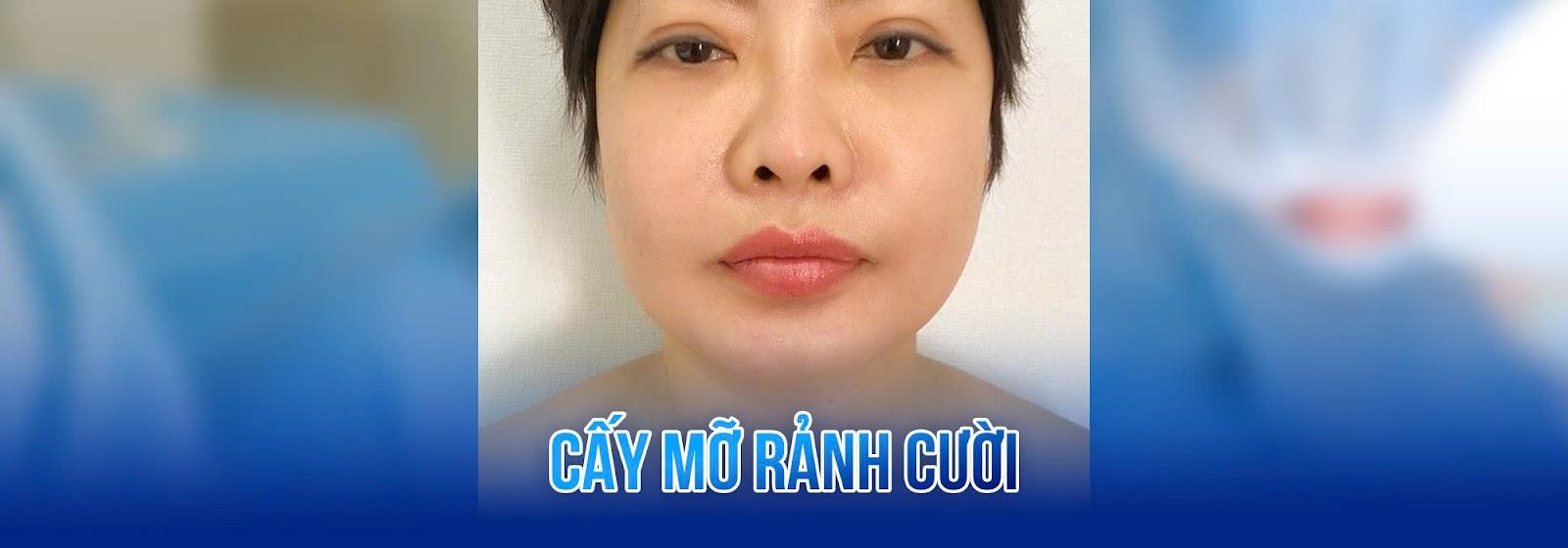 Cấy mỡ vùng rãnh cười