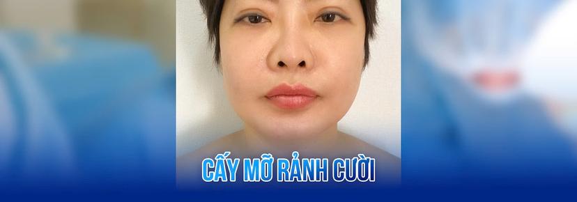 Cấy mỡ vùng rãnh cười