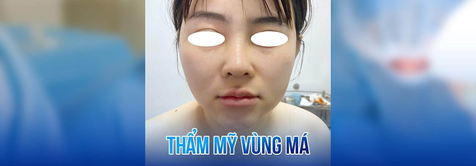 Dịch vụ thẩm mỹ vùng má