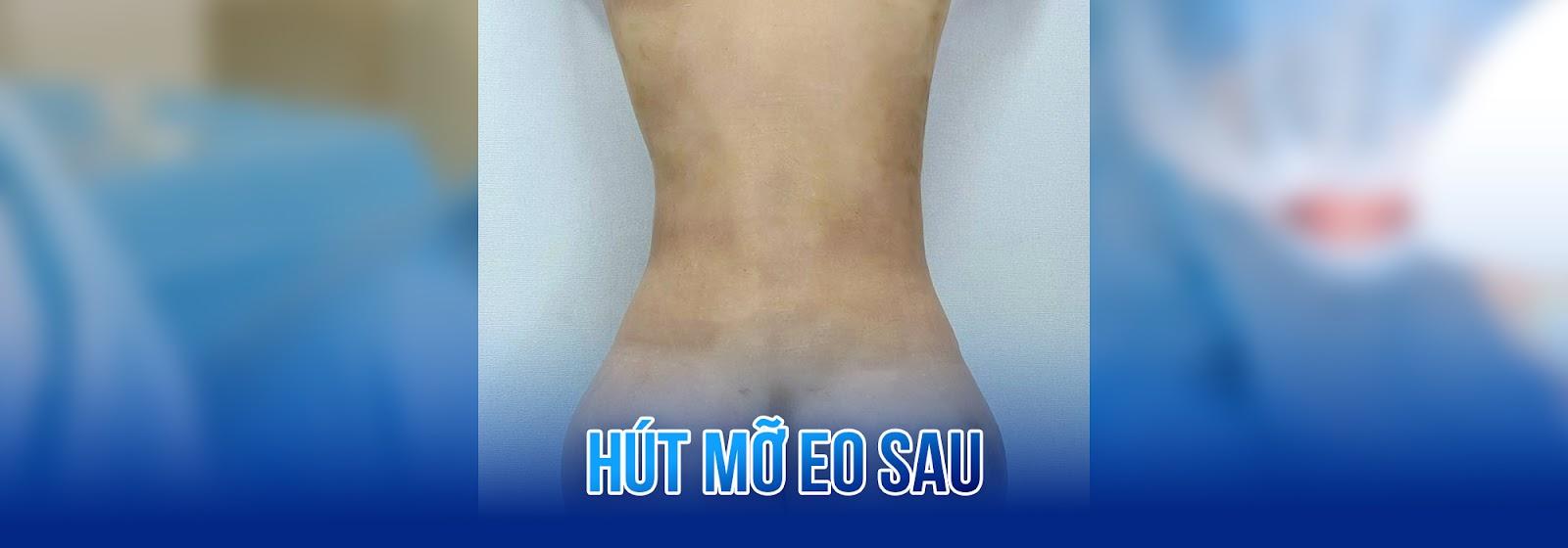 Hút mỡ eo sau