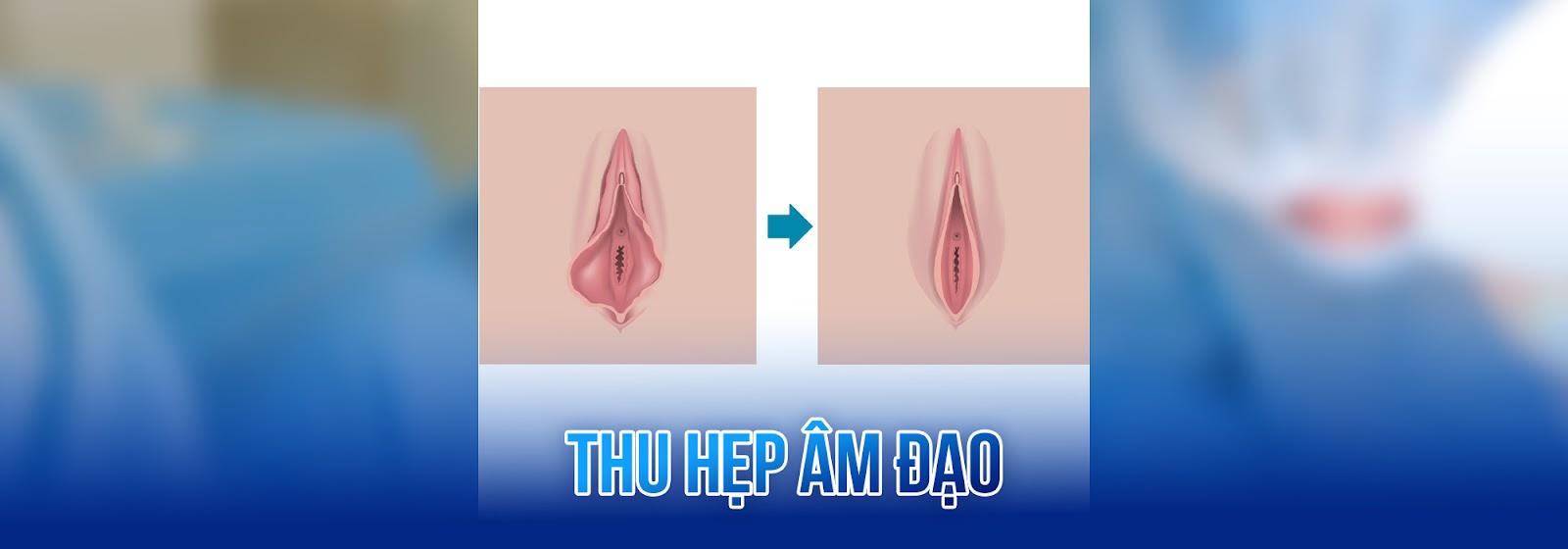 Thẩm mỹ thu hẹp âm đạo