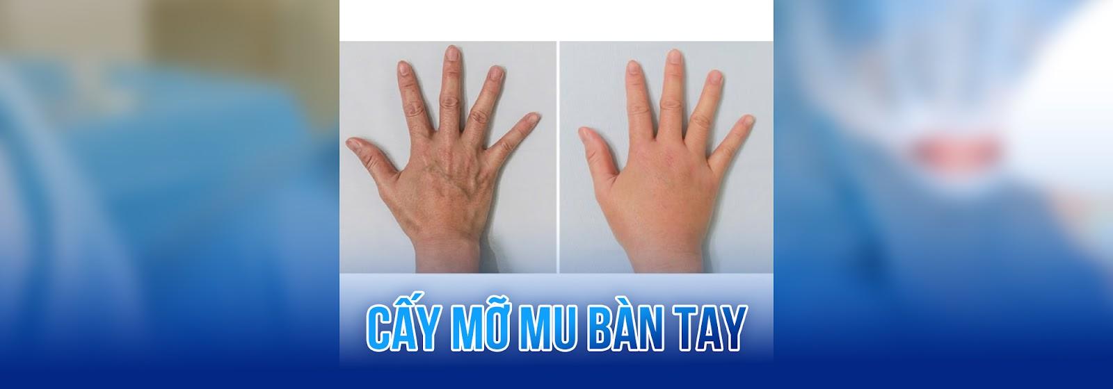 Cấy mỡ mu bàn tay