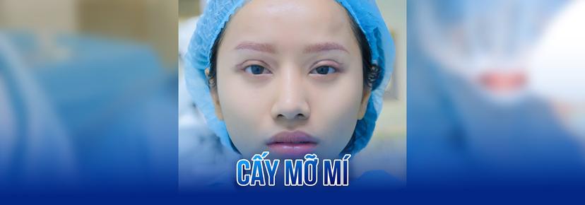 Cấy mỡ mí mắt
