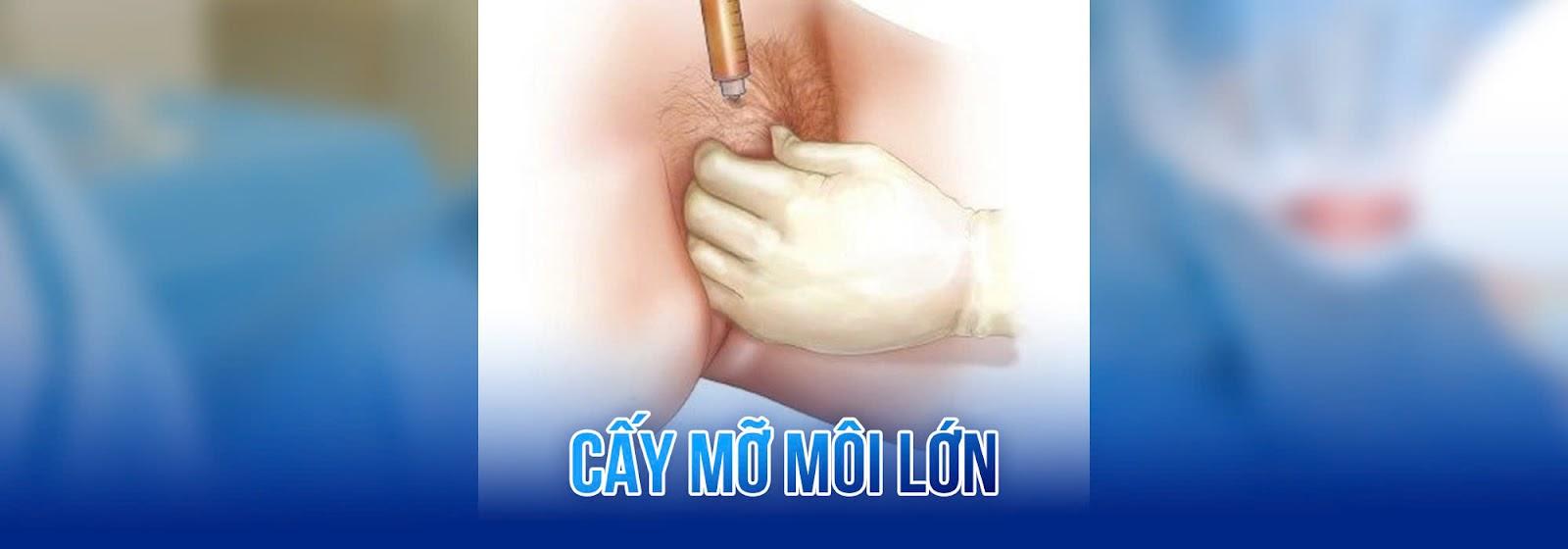 Thẩm mỹ cấy mỡ môi lớn