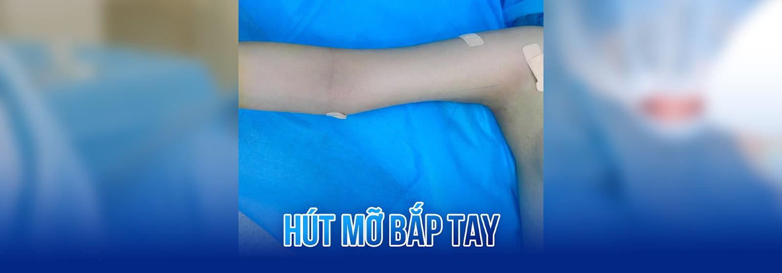 Hút mỡ bắp tay