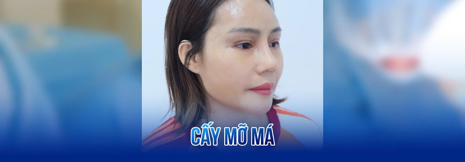 Cấy mỡ tự thân vùng má