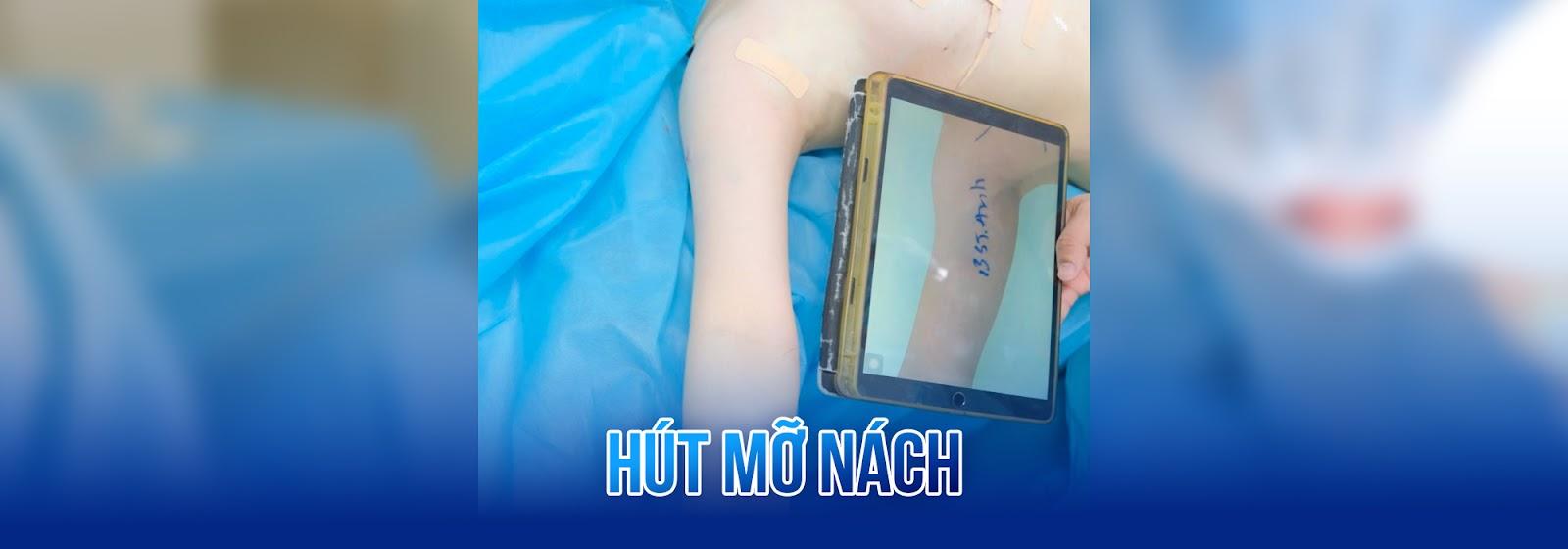 Hút mỡ nách