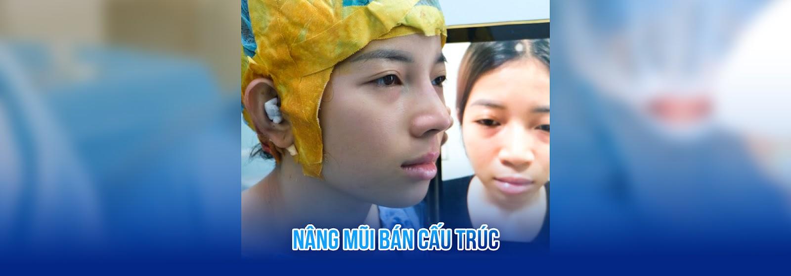 Nâng mũi bán cấu trúc