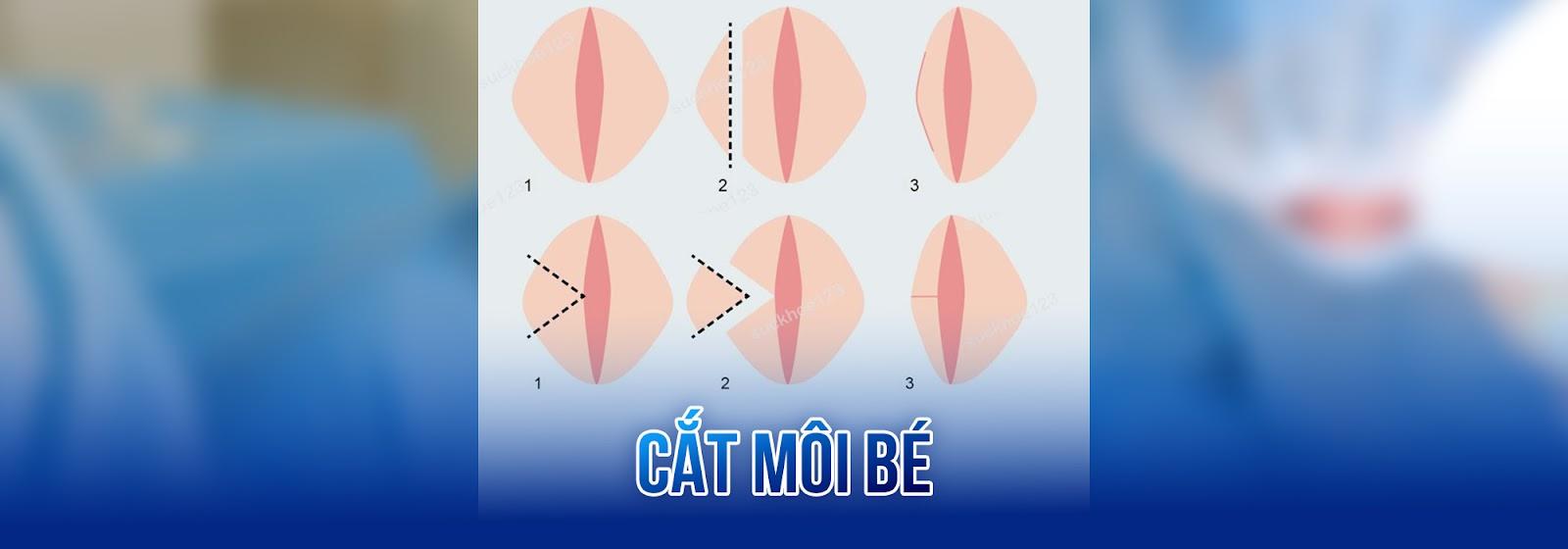 Thẩm mỹ cắt môi bé