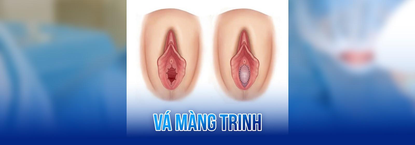 Thẩm mỹ vá màng trinh