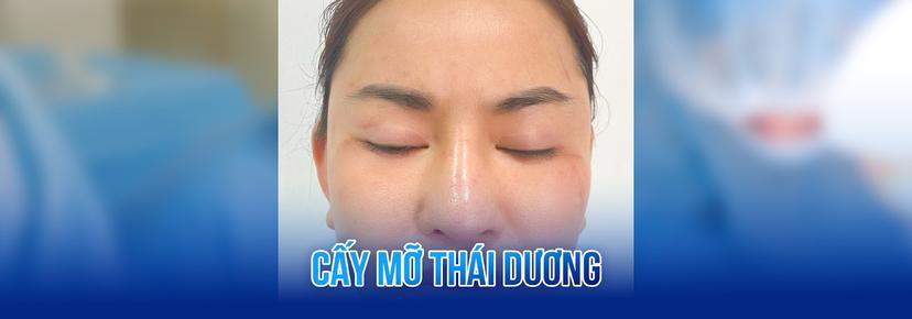Cấy mỡ tự thân thái dương